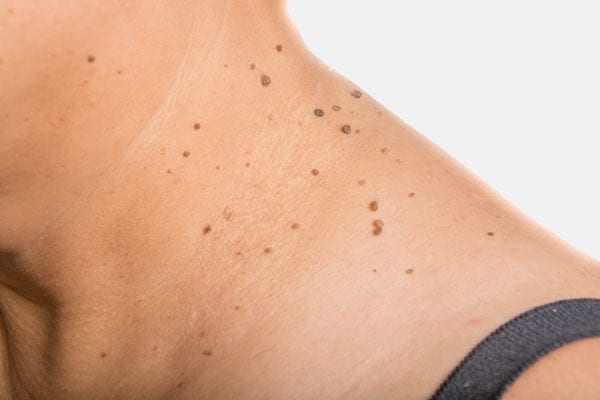 Home Remedies To Get Rid Of Skin Tags!